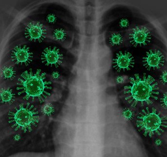 Unusual Cell Death Pathway Linked to Severe COVID-19 Lung Damage