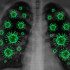 Unusual Cell Death Pathway Linked to Severe COVID-19 Lung Damage